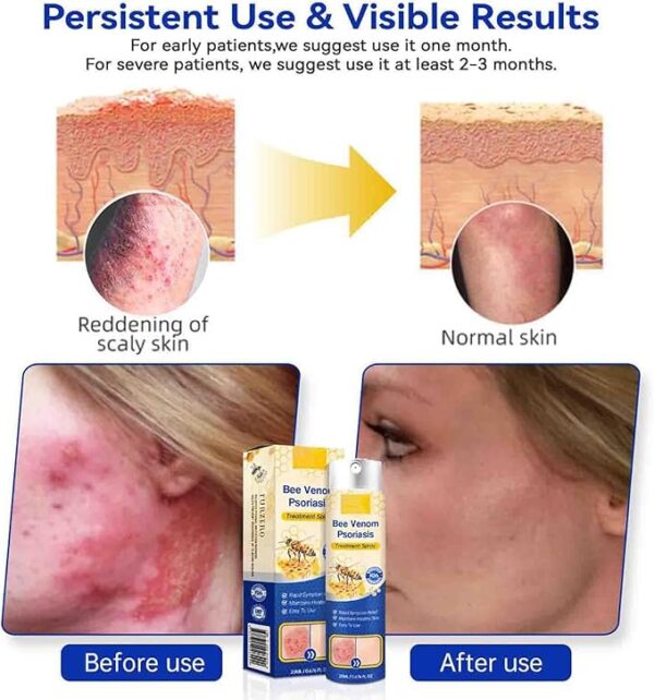 Houkea Bee Venom Psoriasis 20ml - Image 4