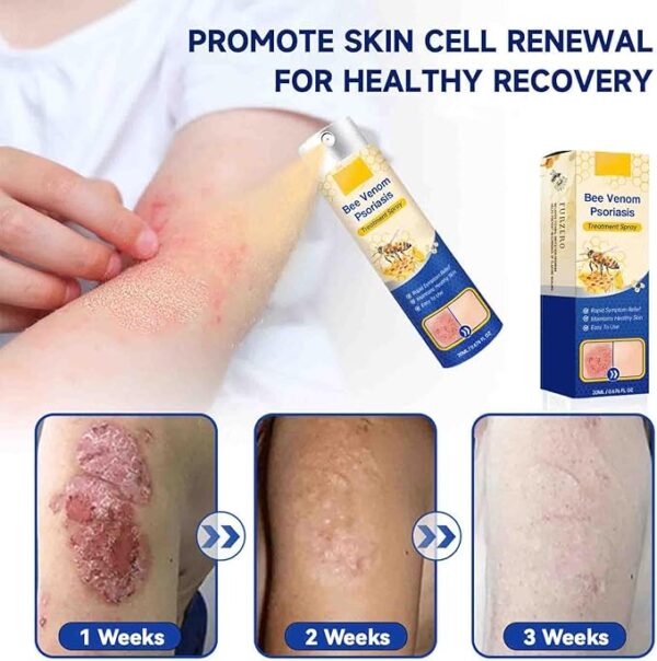 Houkea Bee Venom Psoriasis 20ml - Image 5