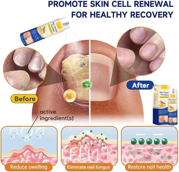 Houkea Bee Venom Psoriasis 20ml - Image 2
